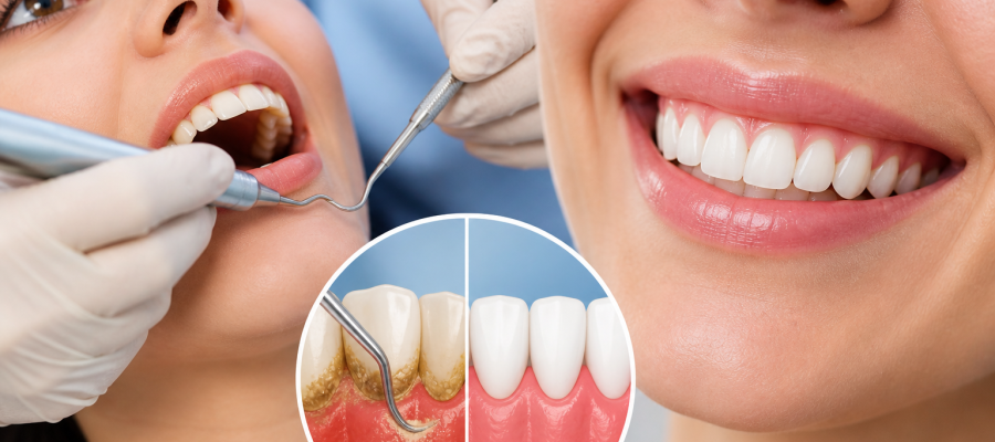 Why Scaling & Root Planing Is Essential for Healthy Gums