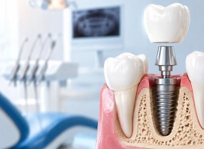 Dental Implants Treatment in Dwarka Sec 11