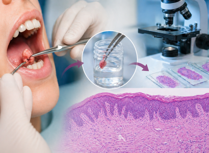 What Is Dental Biopsy? Process, Benefits & Histopathology Explained
