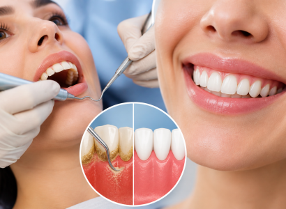 Why Scaling & Root Planing Is Essential for Healthy Gums