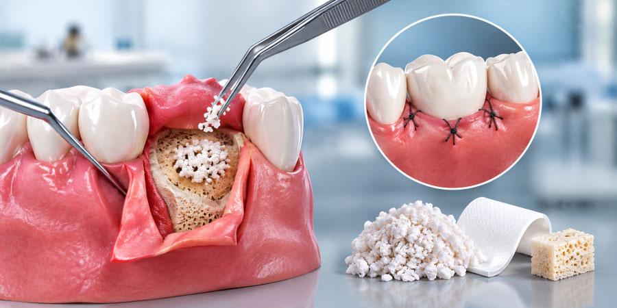 Periodontal Flap Surgeries & Bone Grafting